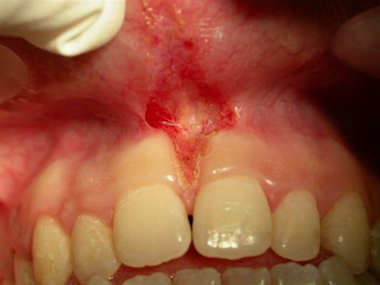 лазеры в хирургической стоматологии